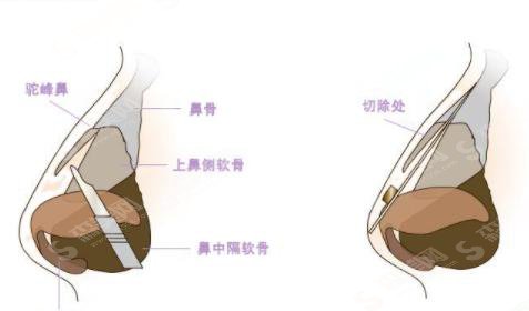 驼峰鼻整形的价格?靠谱吗?附驼峰鼻案例+前后果对比图