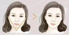 什么是颊脂垫？附去颊脂垫价格及去颊脂垫案例分享
