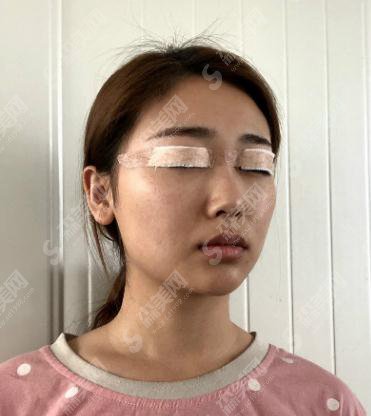 深圳市宝安区人民医院美容整形和烧伤科价目表2020,切开双眼皮案例前后果图