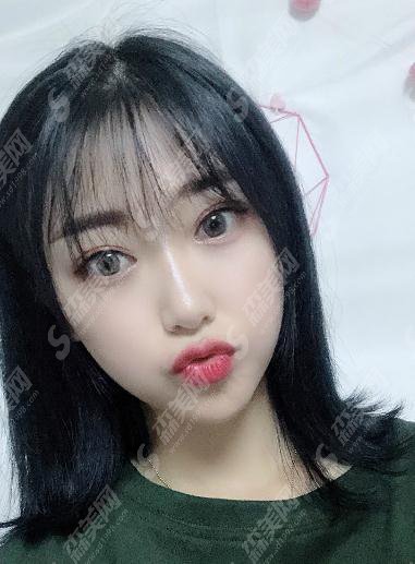 深圳市宝安区人民医院美容整形和烧伤科价目表2020,切开双眼皮案例前后果图