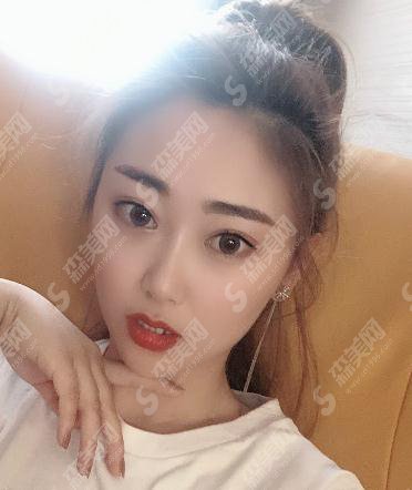 深圳市宝安区人民医院美容整形和烧伤科价目表2020,切开双眼皮案例前后果图