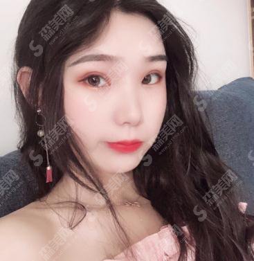 中山大学附属第三医院整形烧伤科价目表2020,内含切开双眼皮案例