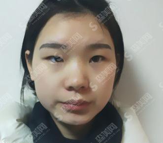 中山大学附属第三医院整形烧伤科价目表2020,内含切开双眼皮案例