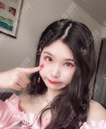 中山大学附属第三医院整形烧伤科价目表2020,内含切开双眼皮案例