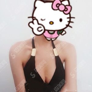 杭州117医院整形科的具体实力介绍/隆胸案例分享/附恢复过程图