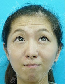 注射瘦脸祛皱的过程分享/术后护理怎么操作/附带注射瘦脸注射恢复前后对比图