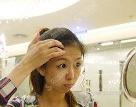 注射瘦脸祛皱的过程分享/术后护理怎么操作/附带注射瘦脸注射恢复前后对比图