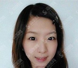 注射瘦脸祛皱的过程分享/术后护理怎么操作/附带注射瘦脸注射恢复前后对比图