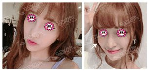 面部填充北京长虹医院怎么样/玻尿酸面部填充的案例分享/内附长虹医院介绍