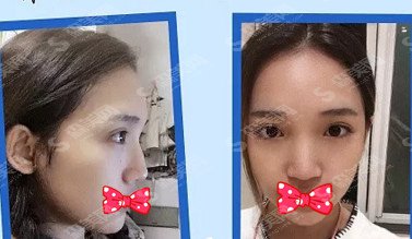 鼻骨缩窄的手术原理/鼻骨缩窄后的果分享/术前术后对比图