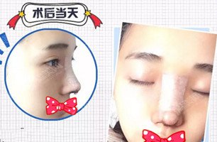 鼻骨缩窄的手术原理/鼻骨缩窄后的果分享/术前术后对比图