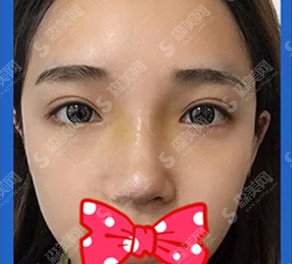 鼻骨缩窄的手术原理/鼻骨缩窄后的果分享/术前术后对比图