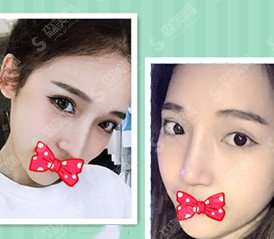 鼻骨缩窄的手术原理/鼻骨缩窄后的果分享/术前术后对比图