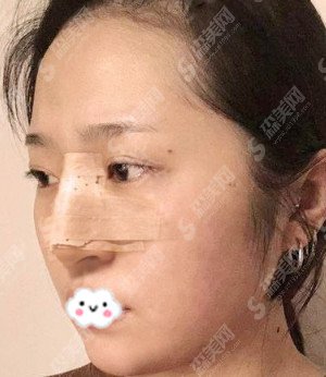 鼻翼缩小对比图果分享/鼻翼缩小案例分享/前后的果图