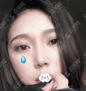 鼻翼缩小对比图果分享/鼻翼缩小案例分享/前后的果图