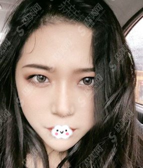 鼻翼缩小对比图果分享/鼻翼缩小案例分享/前后的果图