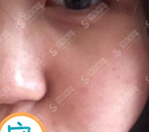 黑脸娃娃的功怎么样/黑脸娃娃做完治疗以后的果/附带黑脸娃娃的恢复图片