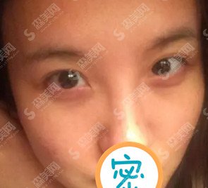 黑脸娃娃的功怎么样/黑脸娃娃做完治疗以后的果/附带黑脸娃娃的恢复图片