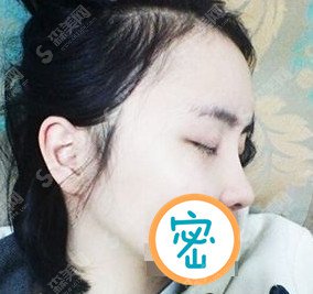 黑脸娃娃的功怎么样/黑脸娃娃做完治疗以后的果/附带黑脸娃娃的恢复图片