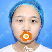 割双眼皮前后对比图/割双眼皮的术后果怎么样/恢复图片展示