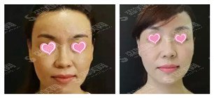 杏林整形医院怎么样/杏林整形医院案例分享/杏林整形医院案例前后对比照