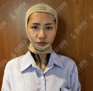 北京301医院整形修复科价目表2020，面部吸脂价格，内含面部吸脂案例果图