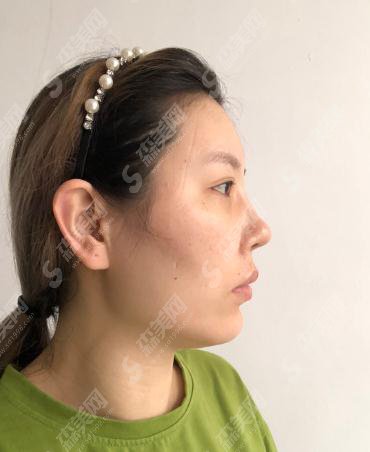 北京307医院整形烧伤科价目表2021,内含颧骨颧弓整形术果前后对比图