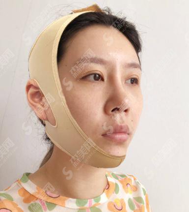 北京307医院整形烧伤科价目表2021,内含颧骨颧弓整形术果前后对比图