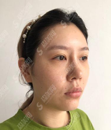 北京307医院整形烧伤科价目表2021,内含颧骨颧弓整形术果前后对比图