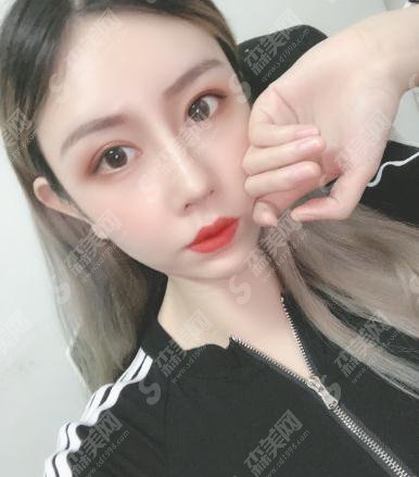 北京307医院整形烧伤科价目表2021,内含颧骨颧弓整形术果前后对比图