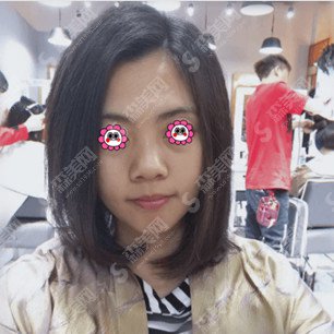 光子嫩肤的好处有哪些/光子嫩肤的治疗果好吗/光子嫩肤的案例分享