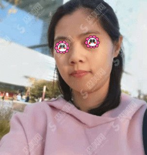 光子嫩肤的好处有哪些/光子嫩肤的治疗果好吗/光子嫩肤的案例分享