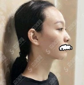 果酸换肤的果怎么样/果酸换肤案例前后对比图/果酸换肤案例分享