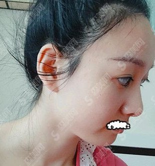 果酸换肤的果怎么样/果酸换肤案例前后对比图/果酸换肤案例分享