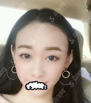 果酸换肤的果怎么样/果酸换肤案例前后对比图/果酸换肤案例分享