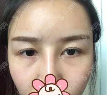 开眼角手术对比图分享/开眼角的术后果怎么样/案例分享
