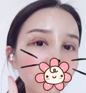 开眼角手术对比图分享/开眼角的术后果怎么样/案例分享