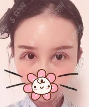 开眼角手术对比图分享/开眼角的术后果怎么样/案例分享