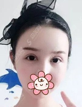 开眼角手术对比图分享/开眼角的术后果怎么样/案例分享