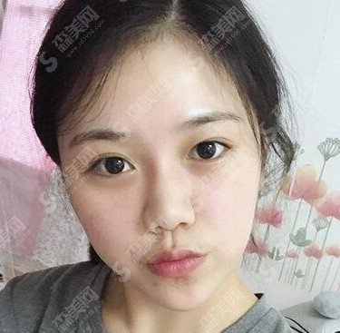 瑞兰除皱的果好吗/瑞兰除皱原理/瑞兰除皱果对比图