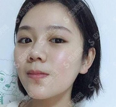 瑞兰除皱的果好吗/瑞兰除皱原理/瑞兰除皱果对比图