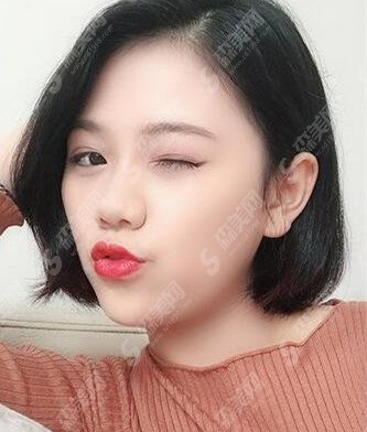 瑞兰除皱的果好吗/瑞兰除皱原理/瑞兰除皱果对比图