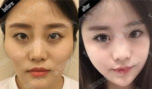 上海美联臣整形医院怎么样/颧骨内推案例分享果图/前后对比图