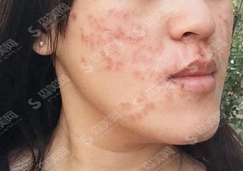 像素激光去痘坑果怎么样的/像素激光去痘坑的案例分享/内附康复过程图