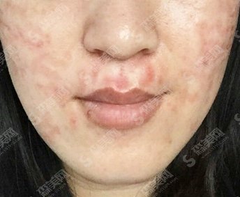像素激光去痘坑果怎么样的/像素激光去痘坑的案例分享/内附康复过程图