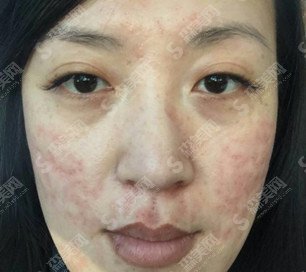 像素激光去痘坑果怎么样的/像素激光去痘坑的案例分享/内附康复过程图