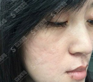 像素激光去痘坑果怎么样的/像素激光去痘坑的案例分享/内附康复过程图