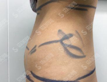 北京电力医院烧伤整形价目表2020,内含腰腹吸脂案例果图