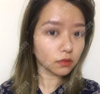 北京市海淀医院价格表2021,隆鼻价格,附肋骨鼻部手术案例果图