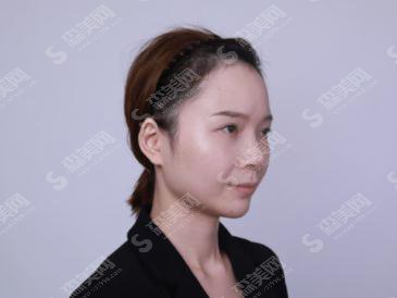 复旦大学附属中山医院青浦分院整形科价目表2020,内含肋软骨隆鼻具体方案果图